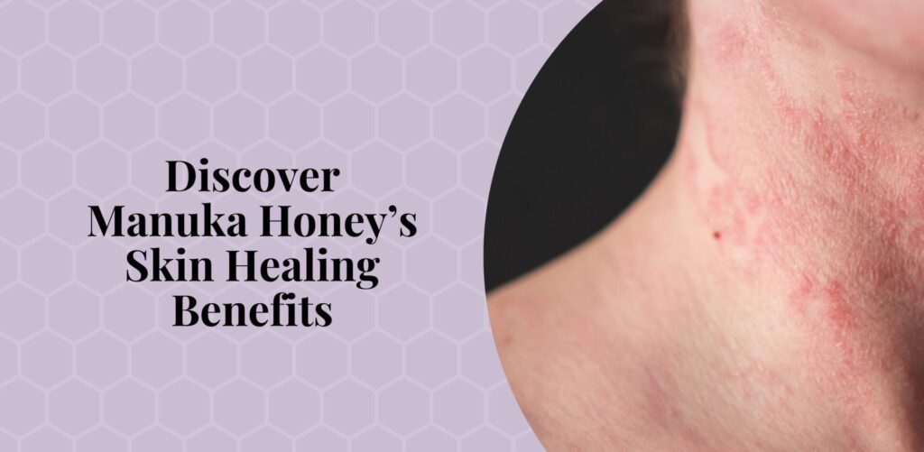 Discover-Manuka-Honey-Skin-Healing-Benefits-Bee-Confident